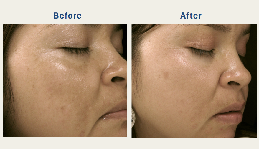 Melarase PM- Nighttime Brightener