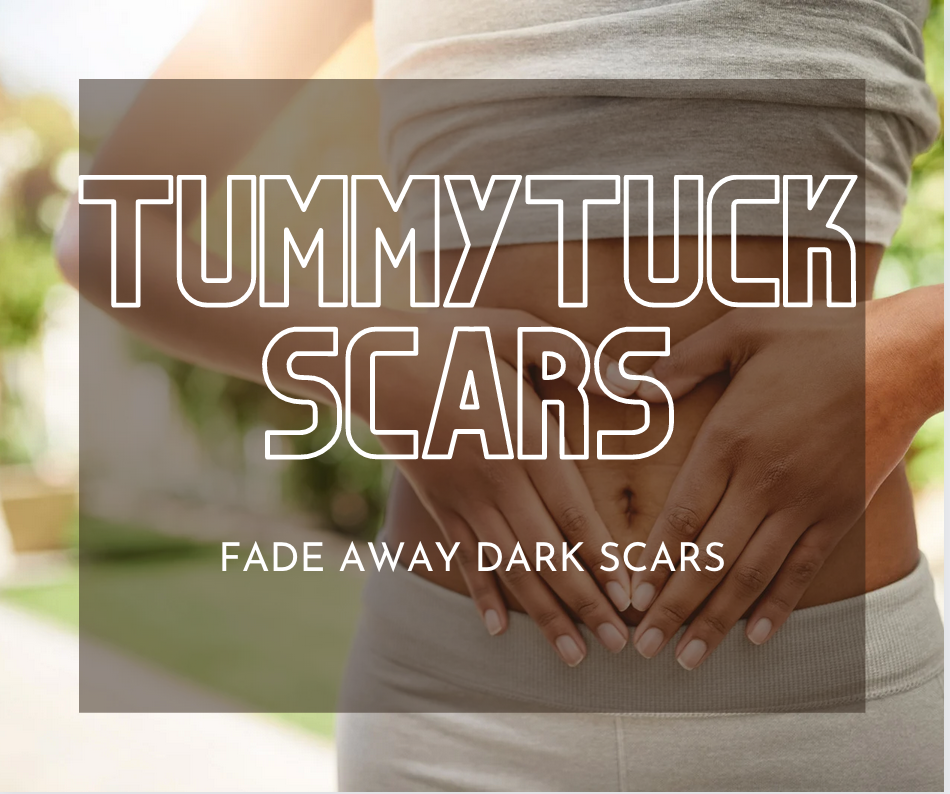 Tips to Fade and Lighten Tummy Tuck Scars (Abdominoplasty)