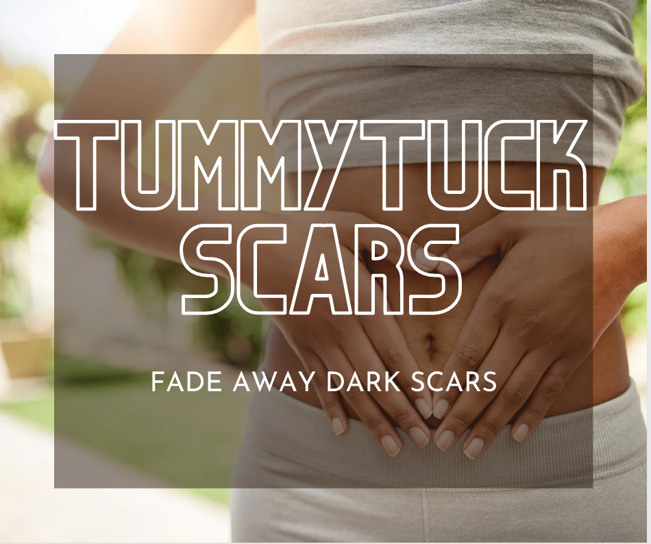 Tips to Fade and Lighten Tummy Tuck Scars (Abdominoplasty) Kare MD